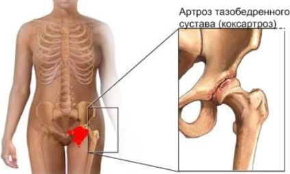 Deformând sold osteoartrita (doa) 1, 2, 3 grade cauze, simptome, tratamentul (șold) Deformând osteoartrita sold (doa) 1, 2, 3 grade cauze, simptome, tratament