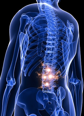 modificări distrofice ale coloanei vertebrale (coloana vertebrală) - Degenerative Degenerativ - modificări degenerative ale coloanei vertebrale