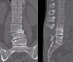 modificări distrofice ale coloanei vertebrale (modificări degenerative-distrofice ale coloanei vertebrale) - degenerativă Degenerativ - modificări degenerative ale coloanei vertebrale