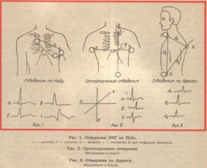 derivațiile suplimentare ECG (conduce) răpire electrocardiografice suplimentară