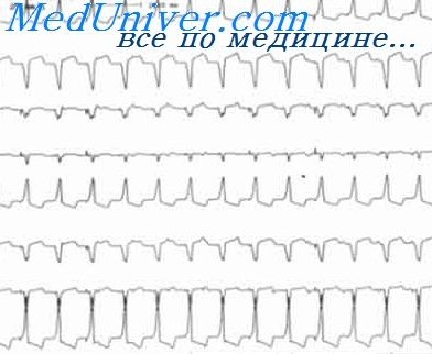 ECG in boala coronariana - tratamentul inimii (coronare) ECG în boala cardiacă ischemică - tratament de inima