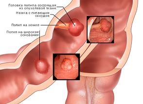 polipectomie endoscopica (polipectomie endoscopice, indepartarea de polipi intestinali) (polipi de colon) polipectomie endoscopica (polipectomie endoscopice, indepartarea polipilor intestinale)