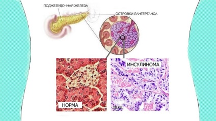 Cum de a reduce sânge medicina populară insulină (insulina) Cum de a reduce insulina în sânge de remedii populare