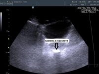 Calcifierea prostatei, ceea ce este, de tratament (de prostată) Calcifierea prostatei, este tratat
