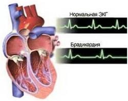 șoc cardiogen (durata acestui stat) șoc cardiogen
