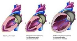 șoc cardiogen (probabilitate de deces) șoc cardiogen