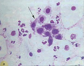 Celulele Metaplazirovannogo epiteliului (epiteliale) Celulele epiteliale metaplazirovannogo