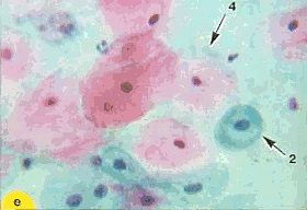 Celulele metaplazirovannogo epiteliului (metaplazirovannogo) Celulele epiteliale metaplazirovannogo