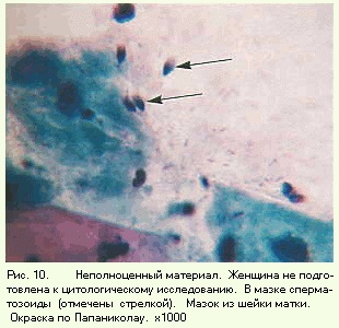 Celulele epiteliale Metaplazirovannogo (celule) Celulele epiteliale metaplazirovannogo