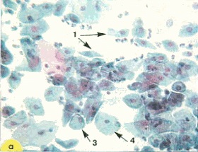 Celulele metaplazirovannogo epiteliului (metaplazirovannogo) Celulele epiteliale metaplazirovannogo