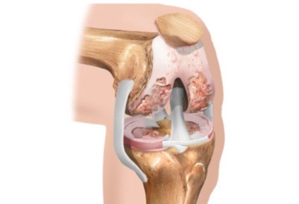 Tratamentul de droguri osteoartrita, medicamente eficiente și sigure, vitamine pentru articulatii (vitamine) Tratamentul de droguri osteoartrita, medicamente eficiente și sigure, vitamine pentru articulații