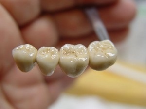 coroane metalo-ceramice pe implante (coroane metalo-ceramice implanturi) coroane metalo-ceramice pe implante