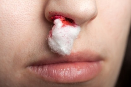 Epistaxis, medicina tradițională (medicament) Epistaxis, medicina populară