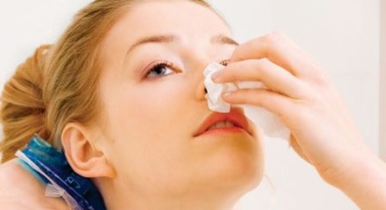 Epistaxis, medicina tradițională (populară) Epistaxis, medicina populară