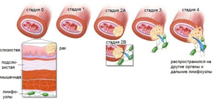 O tumoare a esofagului simptome, semne, tratament (simptome) O tumoare a simptomelor esofagului, semne, tratament