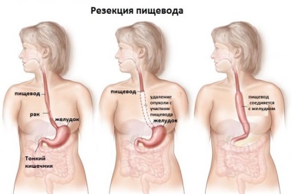 O tumoare a esofagului simptome, semne, tratament (tratament) O tumoare a simptomelor esofagului, semne, tratament