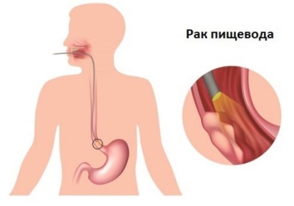 O tumoare a esofagului simptome, semne, tratament (semne) O tumoare a simptomelor esofagului, semne, tratament