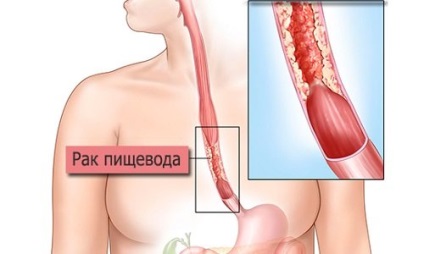 O tumoare a simptomelor esofagului, semne, tratamentul (esofagiene) O tumoare a simptomelor esofagului, semne, tratament