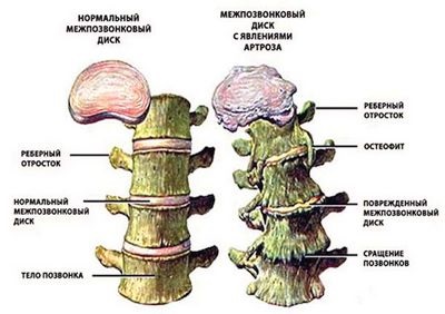 Osteofite la nivelul coloanei vertebrale toracice (osteofite) Osteofite la nivelul coloanei vertebrale toracice