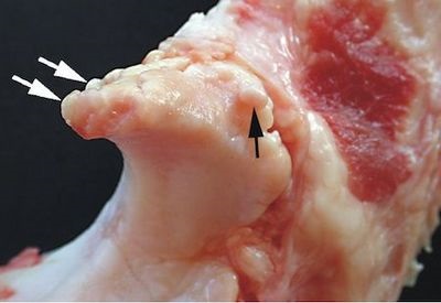 Osteofite la nivelul coloanei vertebrale toracice (toracice) Osteofite la nivelul coloanei vertebrale toracice