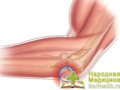 Osteom osului frontal - simptomele, eliminarea, tratarea osteom a sinusului frontal (frontal) Osteom a osului frontal - simptomele, eliminarea, tratarea osteom sinusului frontal