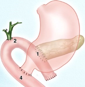 Pancreatoduodenectomy 1 (gastric lumen bontului) pancreatoduodenectomy 1