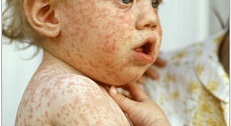 Infecția cu parvovirusul (eritem infectios) - medicina bazata pe dovezi pentru toate (infecțioase) Infecția cu parvovirusul (eritem infectios) - medicina bazata pe dovezi pentru toate