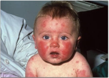 Infecția cu parvovirusul (eritem infectios) - medicina bazata pe dovezi pentru toate (parvovirus) Infecția cu parvovirusul (eritem infectios) - medicina bazata pe dovezi pentru toate