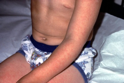 Infecția cu parvovirusul (eritem infectios) - medicina bazata pe dovezi pentru toate (parvovirus) Infecția cu parvovirusul (eritem infectios) - medicina bazata pe dovezi pentru toate