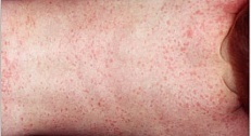 Infecția cu parvovirusul (eritem infectios) - medicina bazata pe dovezi pentru toate (infectia cu parvovirus poate) Infecția cu parvovirusul (eritem infectios) - medicina bazata pe dovezi pentru toate