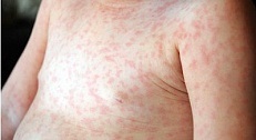 Infecția cu parvovirusul (eritem infectios) - medicina bazata pe dovezi pentru toate (infectia cu parvovirus poate) Infecția cu parvovirusul (eritem infectios) - medicina bazata pe dovezi pentru toate