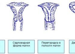 Compartimentarea in uter (partiție) Septul în uter