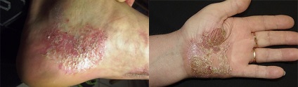Tratamentul psoriazisului pustulos fotografie, manifestarea (psoriazis) Pustulos psoriazis, fotografie, tratament, expresie