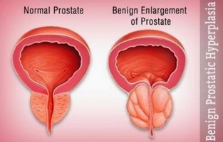 Varietate de tratament chirurgical al adenomului de prostată (chirurgicale) Varietatea de tratament chirurgical al adenomului de prostată