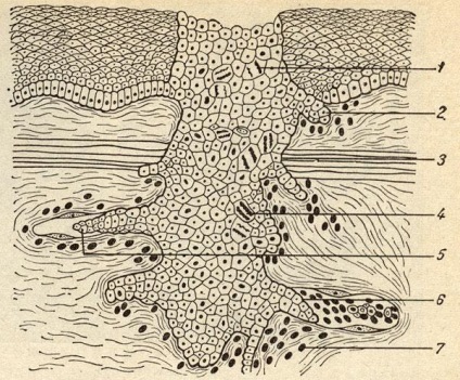 Creșterea tumorii - tumori - anatomie patologică - Cititor de miere (tumoare) Creșterea tumorii - tumori - anatomie patologică - cititor de miere