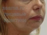 Spasmele și hipertonia mușchilor faciali - poate în sine (triunghiular) Spasmele și hipertonia mușchilor faciali - poate ea însăși