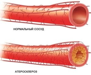 Vasculare cerebrale stenoza, simptome si tratament (ateroscleroza) Stenoza a vaselor cerebrale, simptome și tratament