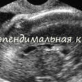 Vasculare cerebrale stenoza, simptome și tratament (tratament) Stenoza a vaselor cerebrale, simptome și tratament