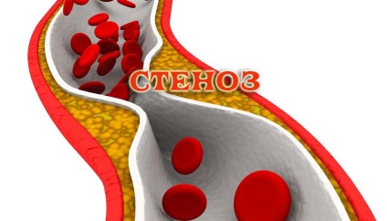 Vasculare cerebrale stenoza, simptome și tratament (stenoza) Stenoza a vaselor cerebrale, simptome și tratament