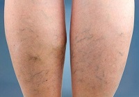 Îndepărtarea cu laser a venelor la nivelul picioarelor sau scleroterapii (laser) Îndepărtarea cu laser a venelor de pe picioare sau scleroterapii
