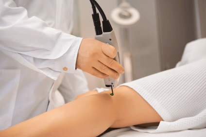 Îndepărtarea cu laser a venelor la nivelul picioarelor sau scleroterapii (asteriscuri) Îndepărtarea cu laser a venelor de pe picioare sau scleroterapii
