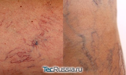 Eliminarea navelor pe fata si picioare cu laser - efecte foto gratuite, recenzii și prețuri (cu laser) Eliminarea navelor pe fata si picioare cu laser - efecte foto gratuite, recenzii și prețuri