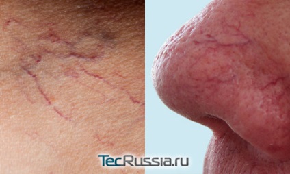 Eliminarea navelor pe fata si picioare cu laser - efecte foto gratuite, recenzii și prețurile (posibil) Eliminarea navelor pe fata si picioare cu laser - efecte foto gratuite, recenzii și prețuri