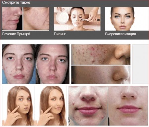 Acnee tratament, fotografii și comentarii - consultație medicală (răspunsuri) Acnee tratament, fotografii și comentarii - consultație medicală