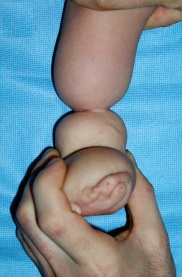 constricție Amniotic (gâtuire) band amniotic