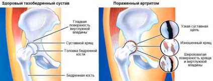 șold artrita la copii (artrita șold) artrita de șold la copii