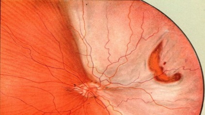 Retiniana atrofierea ochii ce este, tratamentul (a) Ochii retiniana atrofierea ce este, tratament