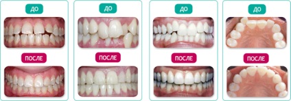 Bretele pe credit in pret Bucuresti, fotografii (aparat dentar) Bretele pe credit din Bucuresti Pret, Foto
