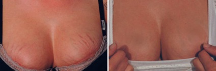 piele curată timp de 2 luni, vă voi spune cum sa scapi de vergeturi pentru totdeauna! (Scapă de) piele curată timp de 2 luni, vă voi spune cum sa scapi de vergeturi pentru totdeauna!