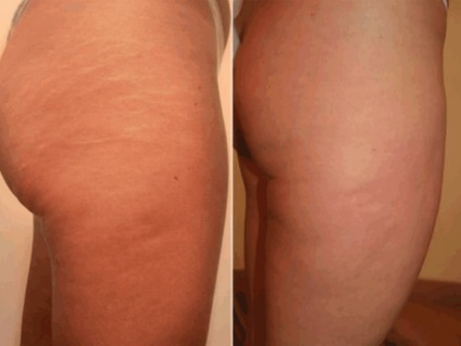 piele curată timp de 2 luni, vă voi spune cum sa scapi de vergeturi pentru totdeauna! (Stretching) piele curată timp de 2 luni, vă voi spune cum sa scapi de vergeturi pentru totdeauna!